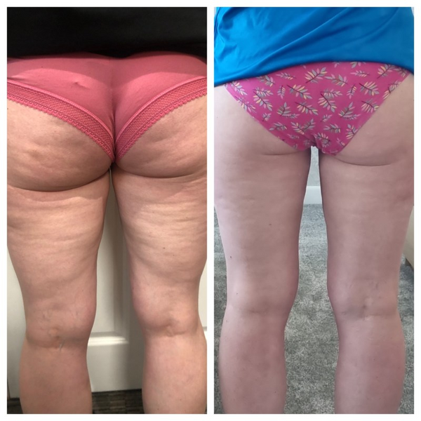 Karen B. before